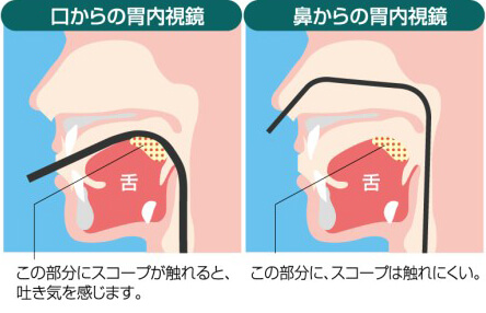 口からの胃内視鏡 鼻からの胃内視鏡